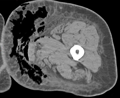 Figure 2 for case Necrotizing fasciitis ( RID3447 )